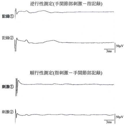 右示指橈側指神経の記録