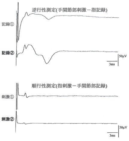 左中指尺側指神経の記録