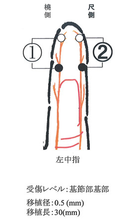 左中指尺側指神経の図解