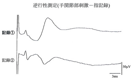左母指橈側指神経の記録