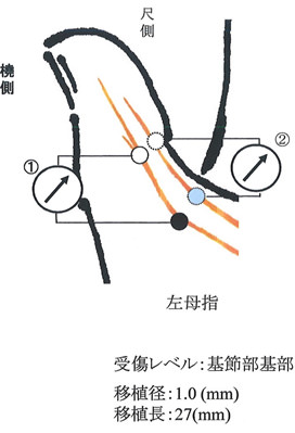 左母指橈側指神経の図解