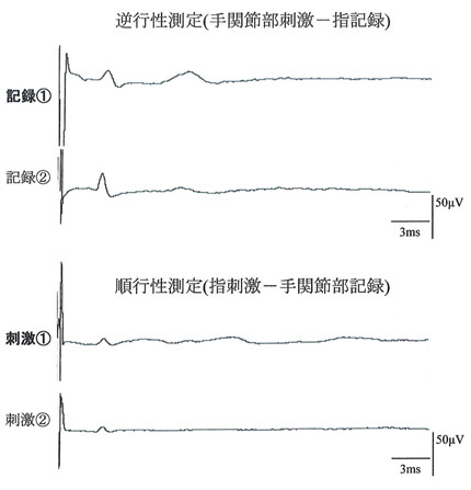 左示指橈側指神経の記録