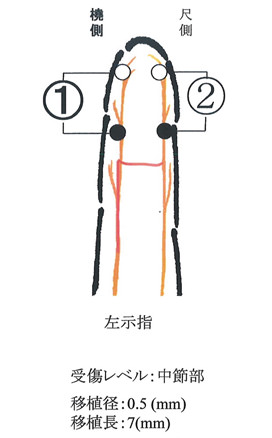左示指橈側指神経の図解