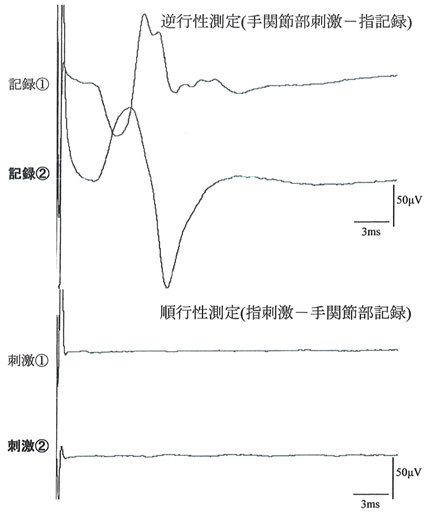 左母指尺側指神経の記録