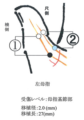 左母指尺側指神経の図解