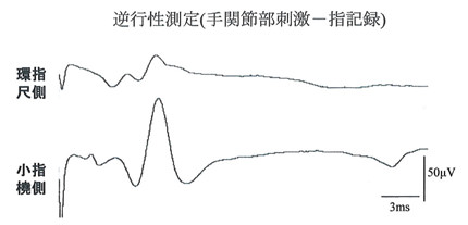 右尺骨神経知覚枝の記録