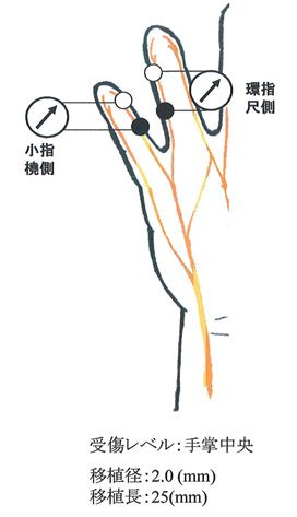 右尺骨神経知覚枝の図解