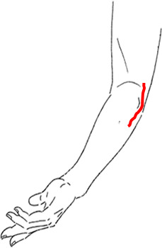 右尺骨神経再建 尺側手根屈筋（随意収縮時）の図解